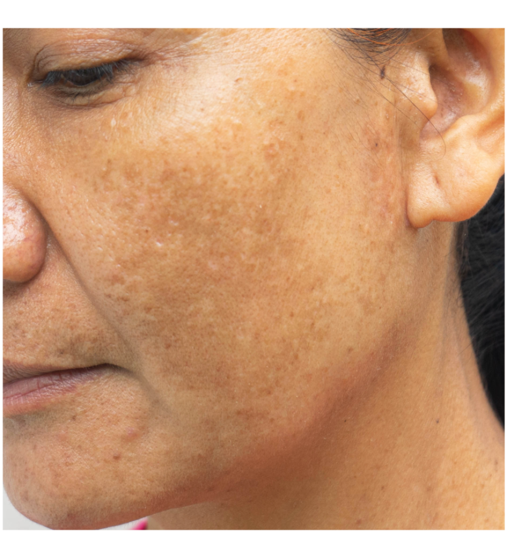 Melasma-Grau-2-21-1024x1024