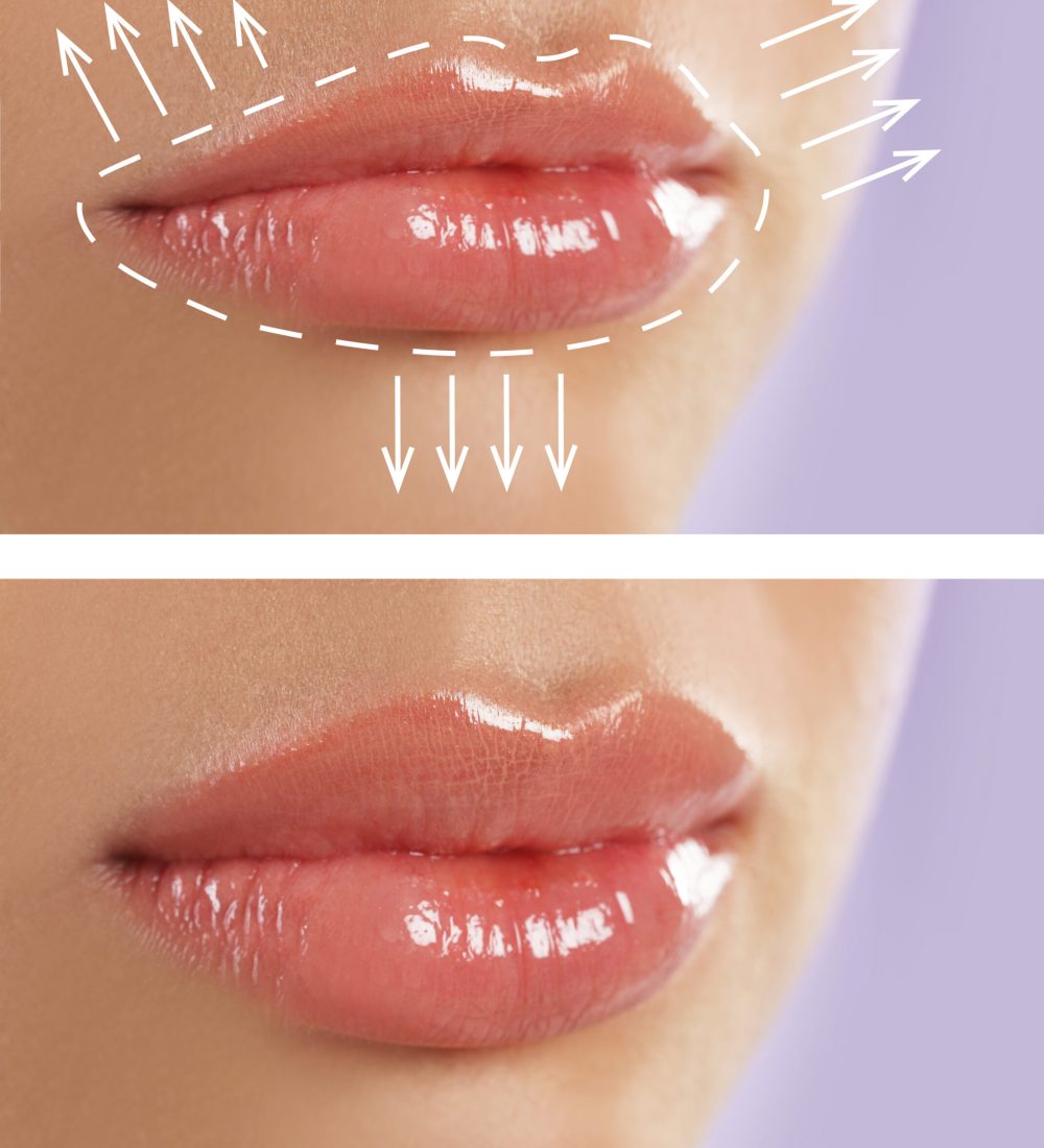 Collage with photos of young woman before and after lips augmentation procedure, closeup